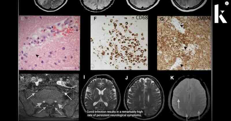 Covid attacks the brain neurological health crisis